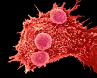 Akciğer Kanserli Hastada İlk Defa CRISPR-Cas9 Tekniği ile  Düzeltilmiş Hücre Nakli.....