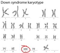  DOWN SENDROMLU HER ÇOCUĞUMUZ  KESİNLİKLE KROMOZOM ANALİZİ YAPTIRMALI